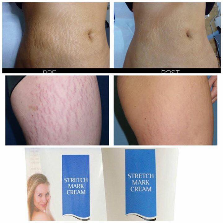 Provamed Stretch Mark Cream