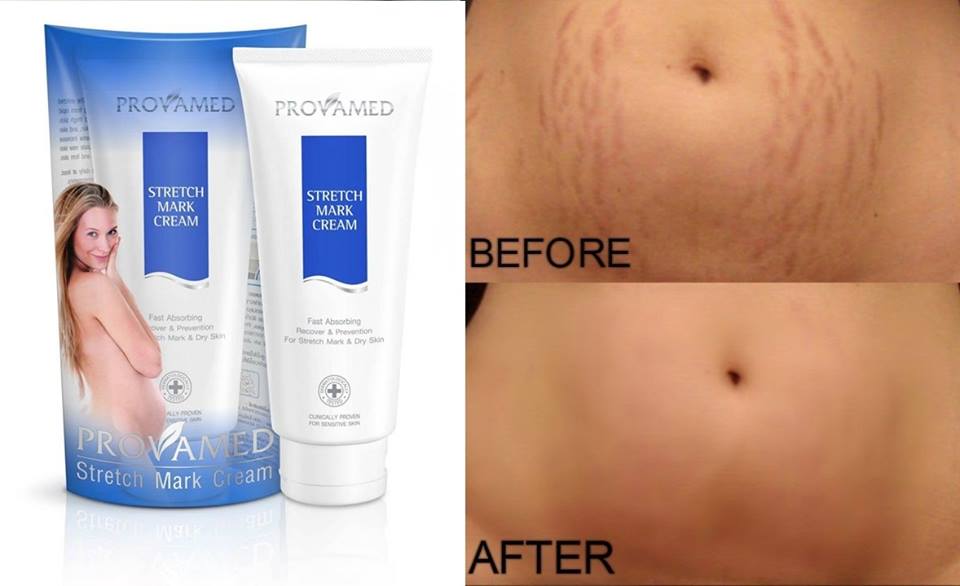 Provamed Stretch Mark Cream