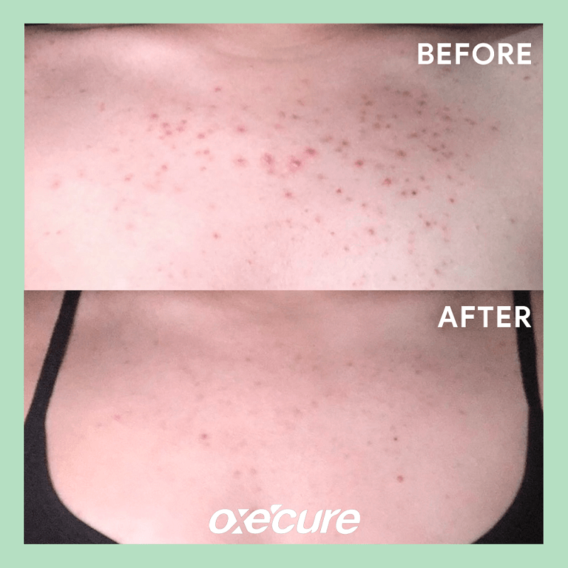 Oxe Cure Body Acne Spray