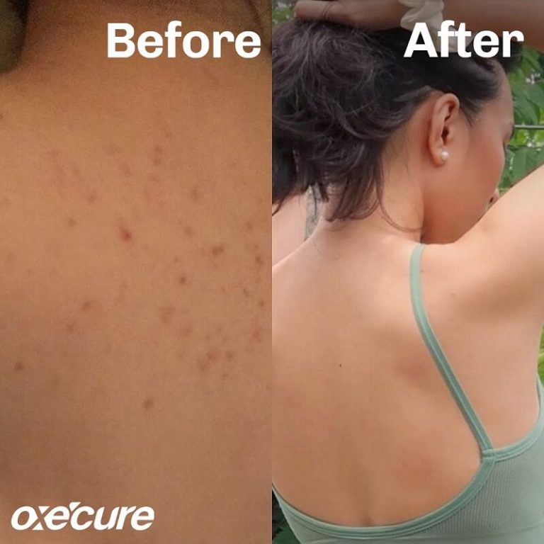 OxeCure Body Acne Spray - Thailand Best Selling Beauty Products - No.1 ...