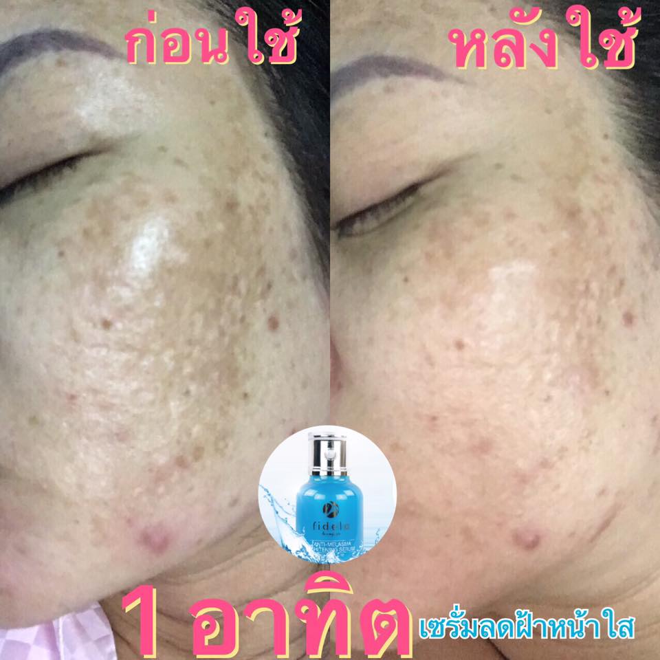Fidela ANTI-MELASMA