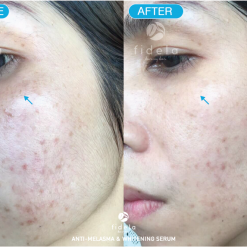 Fidela ANTI-MELASMA
