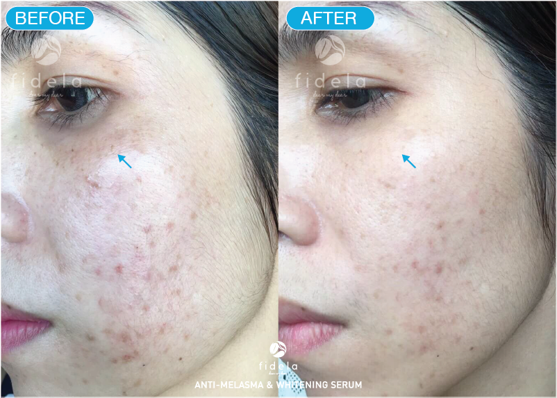 Fidela ANTI-MELASMA