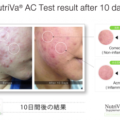anti acne