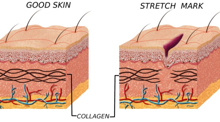 stretch marks removal