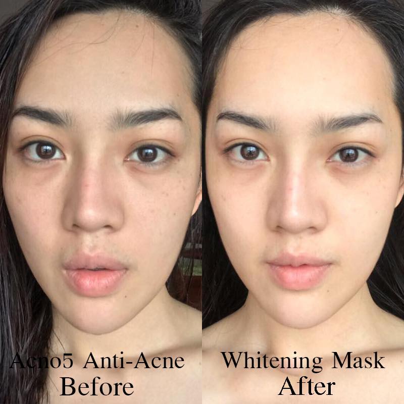 Acno5 Anti-Acne Whitening Mask