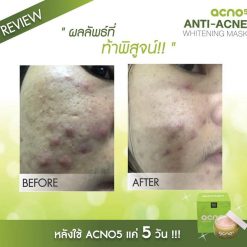 Acno5 Anti-Acne Whitening Mask