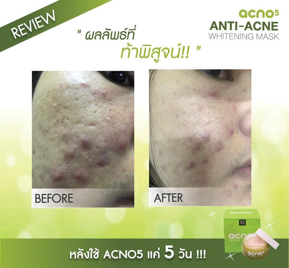 Acno5 Anti-Acne Whitening Mask