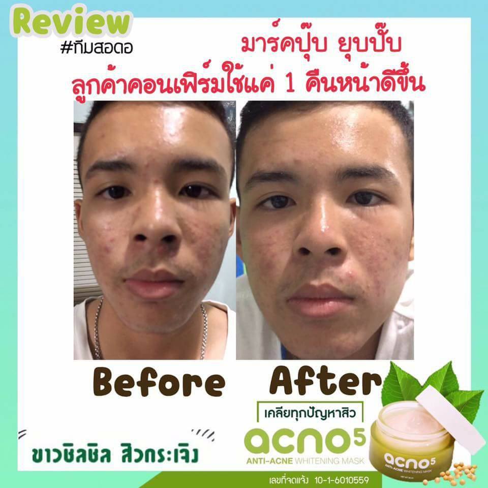 Acno5 Anti-Acne Whitening Mask