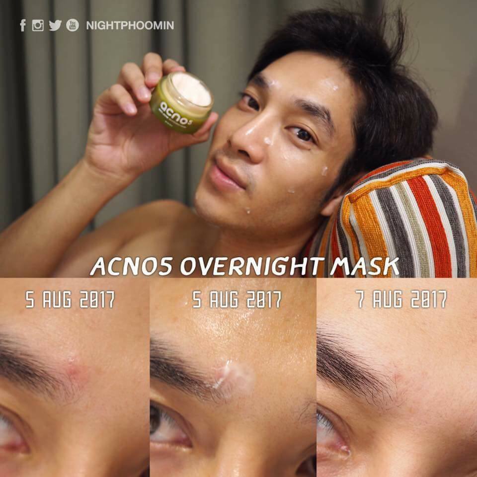 Acno5 Anti-Acne Whitening Mask