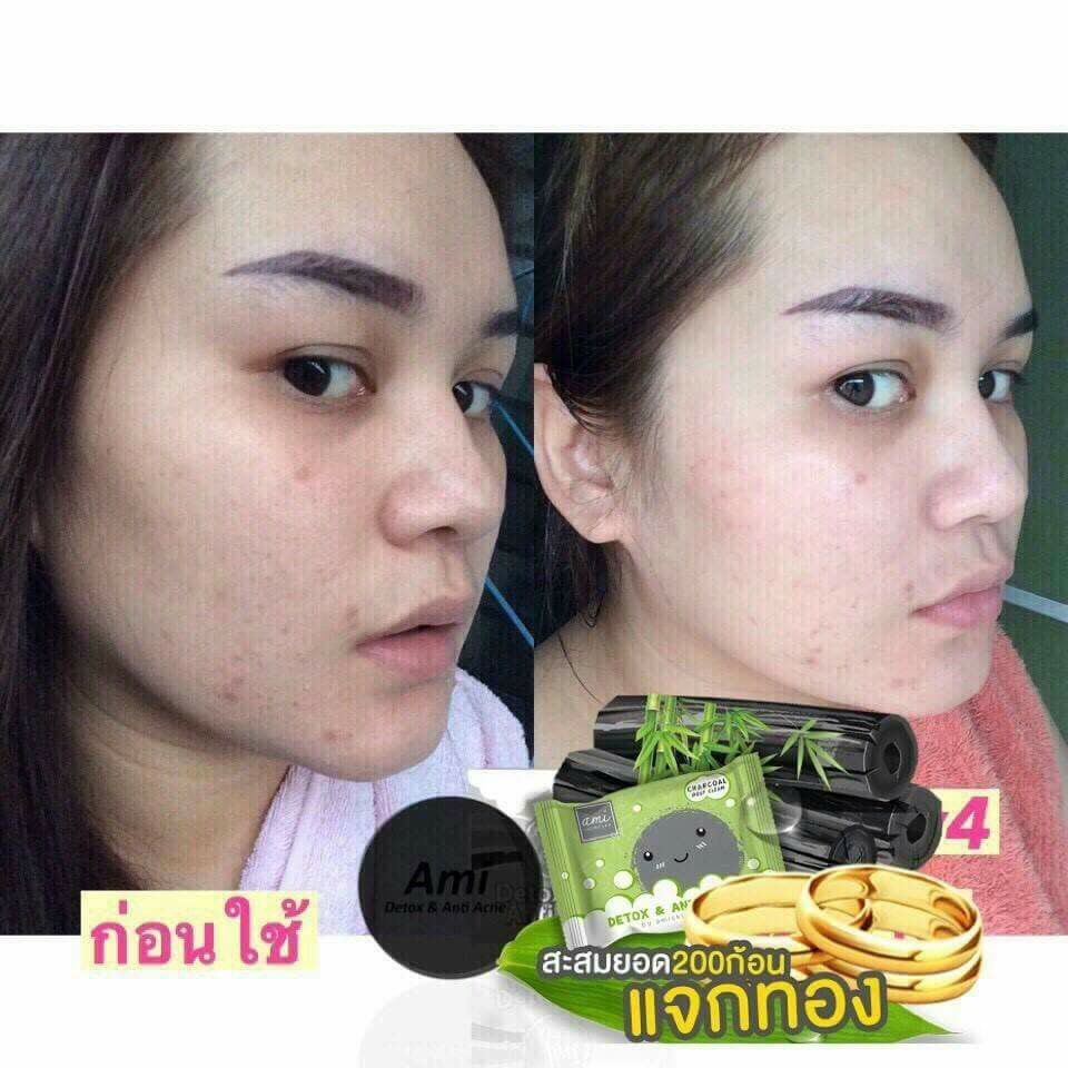 DETOX & ANTI ACNE by ami SKINCARE is the detox soap to treat all acne problems and the cause of acne. It helps absorb toxic substances and prevents skin from pollution in each day. It excellently cleanses the face thoroughly and detoxifies skin within one step.