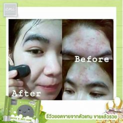 DETOX & ANTI ACNE by ami SKINCARE is the detox soap to treat all acne problems and the cause of acne. It helps absorb toxic substances and prevents skin from pollution in each day. It excellently cleanses the face thoroughly and detoxifies skin within one step.