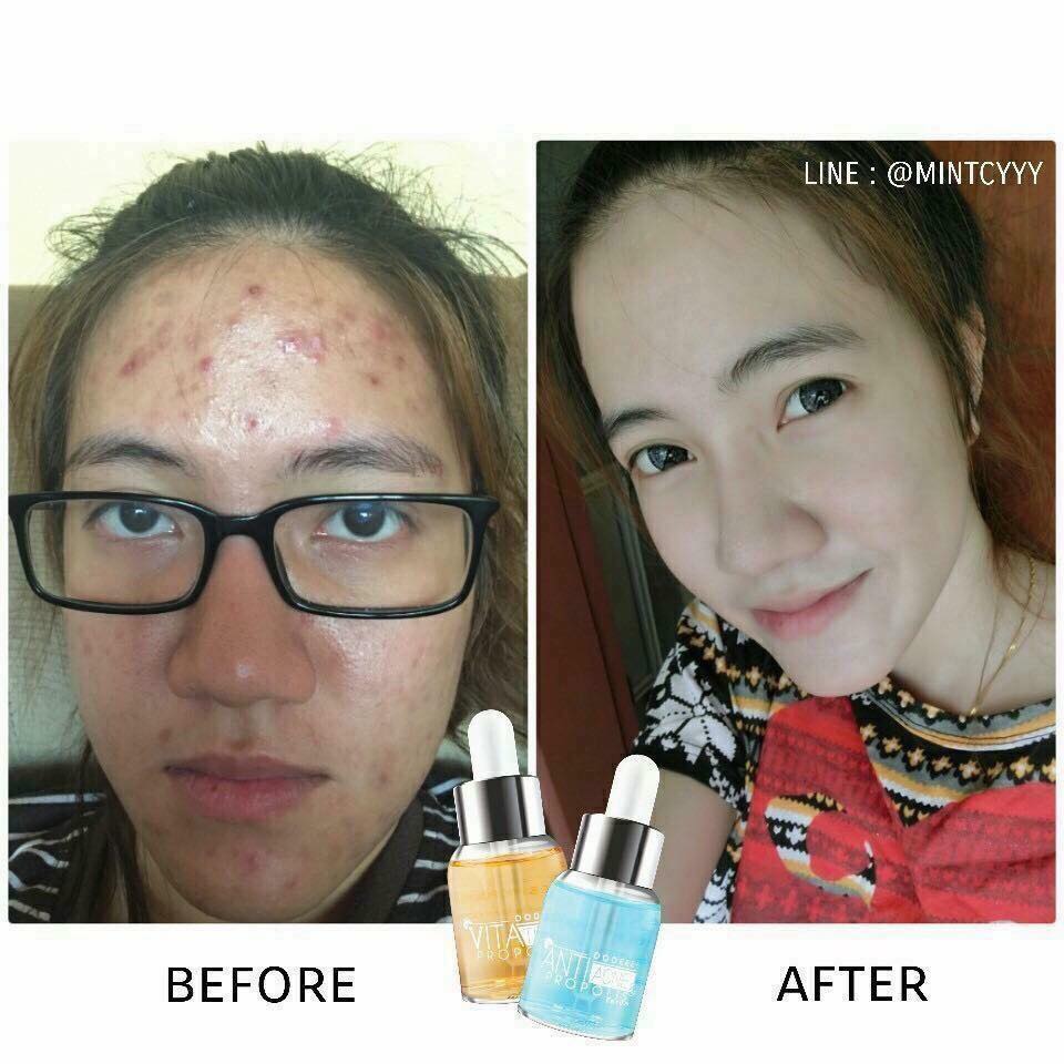 Anti Acne & Propolis Serum