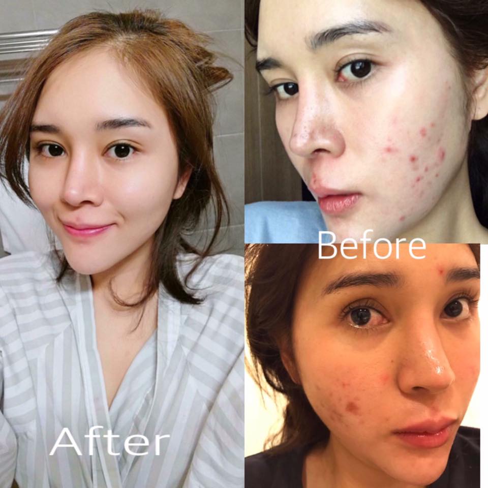 Anti Acne & Propolis Serum