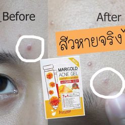 Marigold Acne Gel