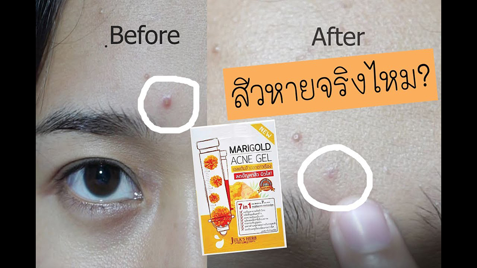 Marigold Acne Gel