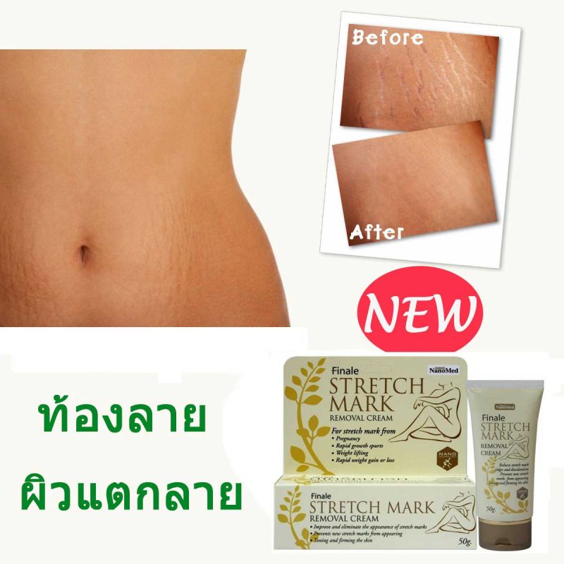 Finale Stretch Mark Removal Cream