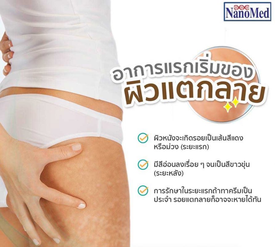 Finale Stretch Mark Removal Cream