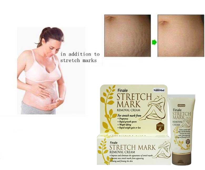 Finale Stretch Mark Removal Cream