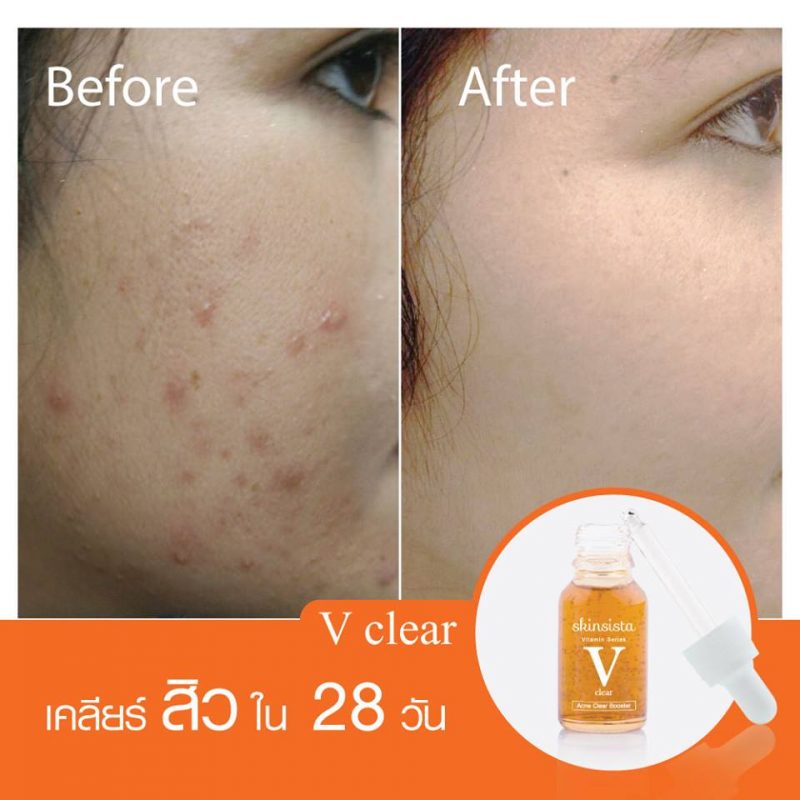 Skinsista V Clear Acne Clear Booster