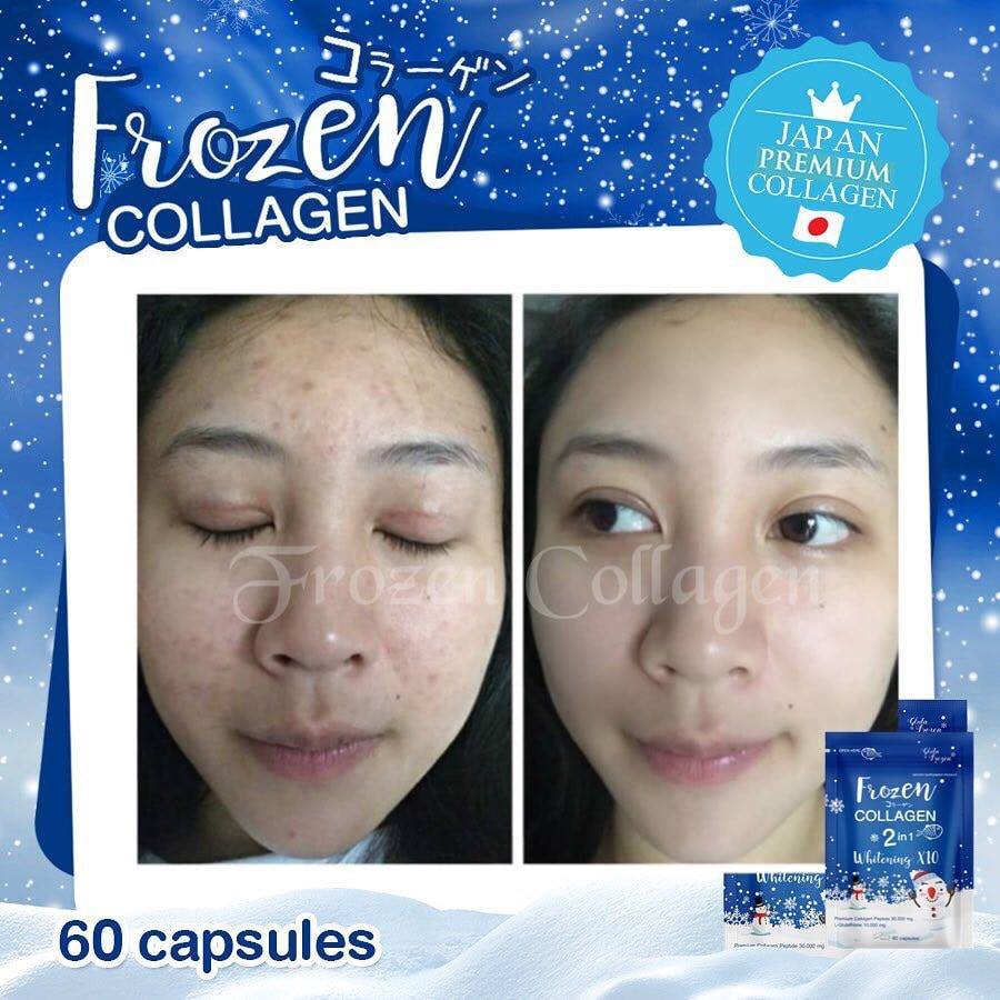 Frozen Collagen