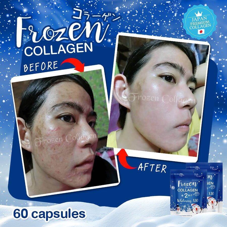 Frozen Collagen