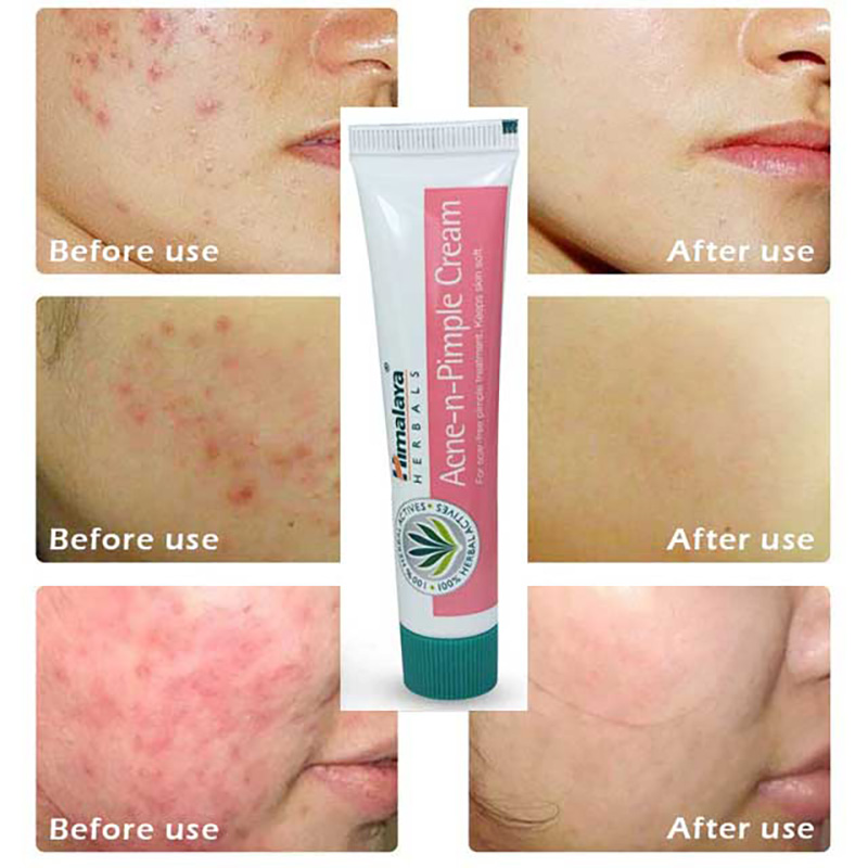 Himalaya Herbals Acne-n-Pimple Cream