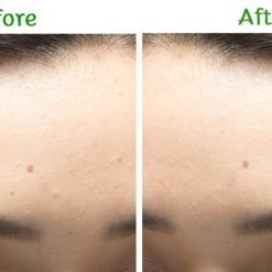 Dr.Somchai Acne Spot Touch Gel