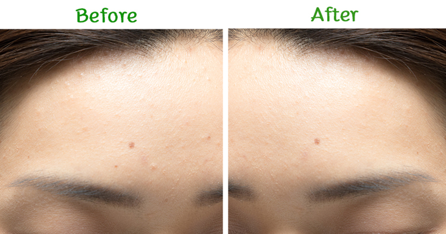 Dr.Somchai Acne Spot Touch Gel