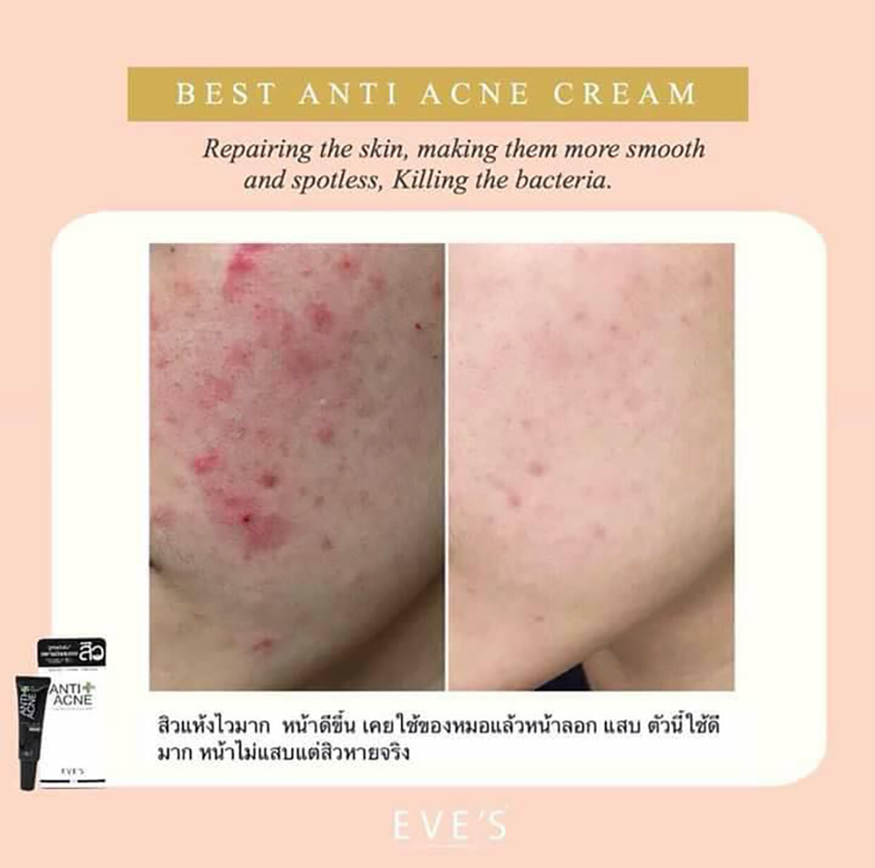 EVE'S Anti Acne Charcoal Cream