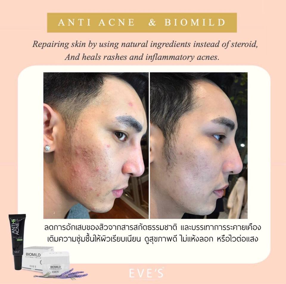 EVE'S Anti Acne Charcoal Cream