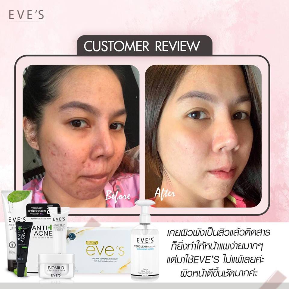 EVE'S Anti Acne Charcoal Cream