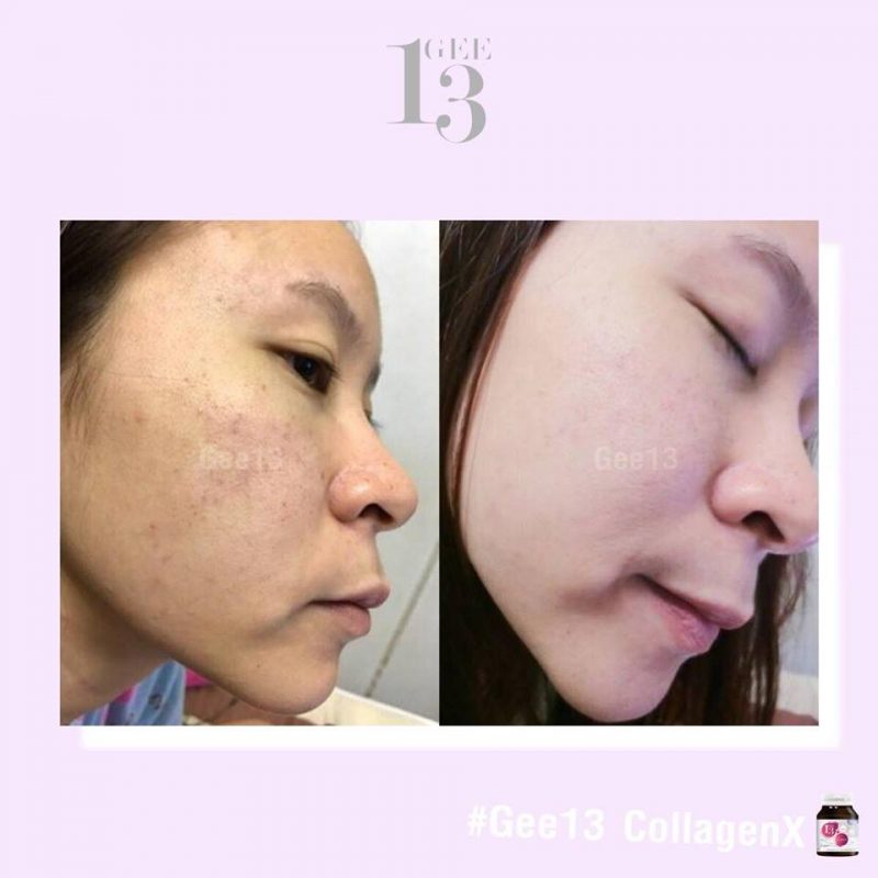 Gee13 Collagen X