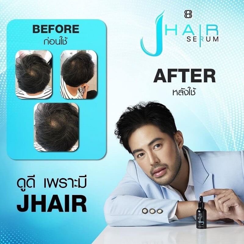 Hair loss treatment for men