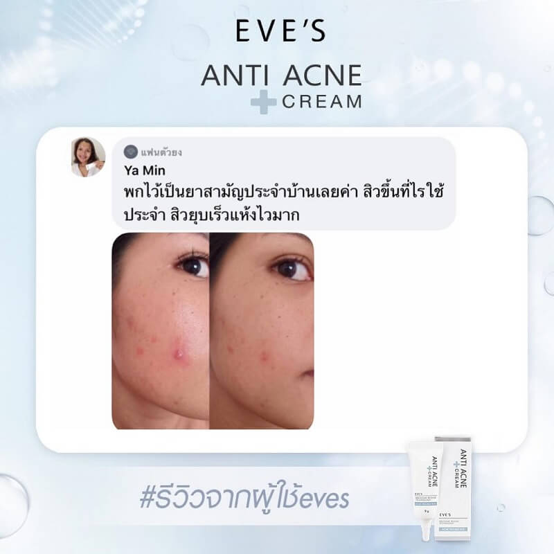 EVE'S Anti Acne Cream - Thailand Best Selling Products - Online