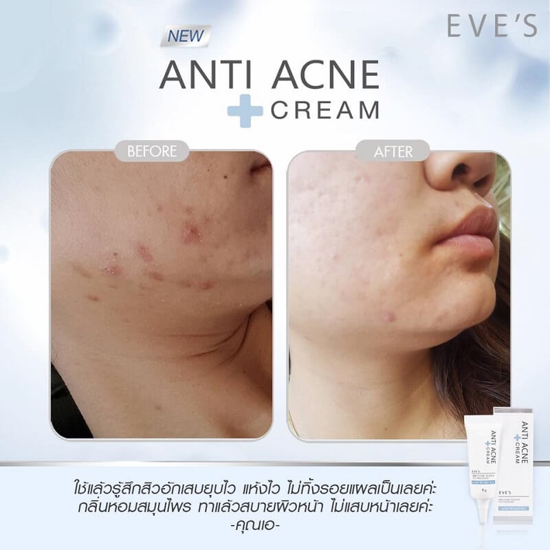 EVE'S Anti Acne Cream