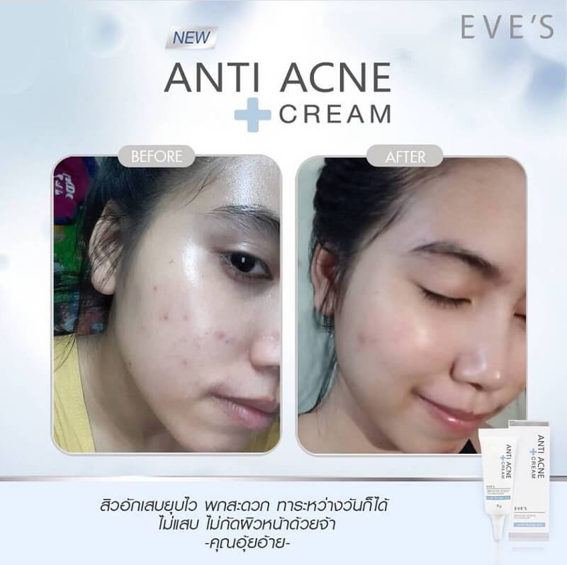 EVE'S Anti Acne Cream