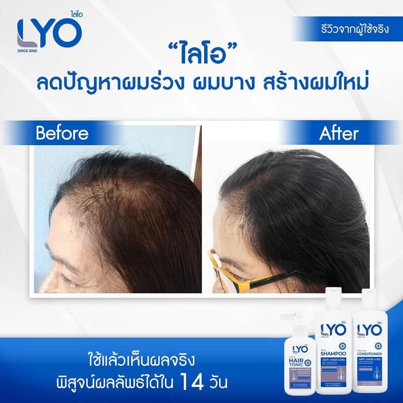 Lyo Hair Tonic 