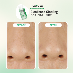 Oxe Cure Blackhead Clearing BHA PHA Toner