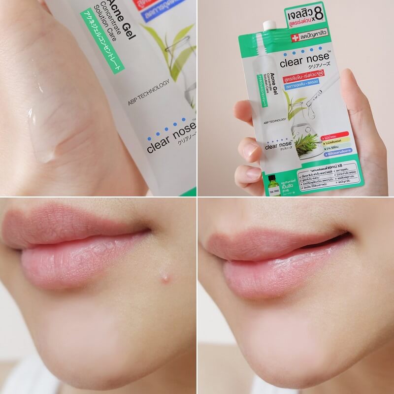 Clear Nose Acne Gel Concentrate Solution