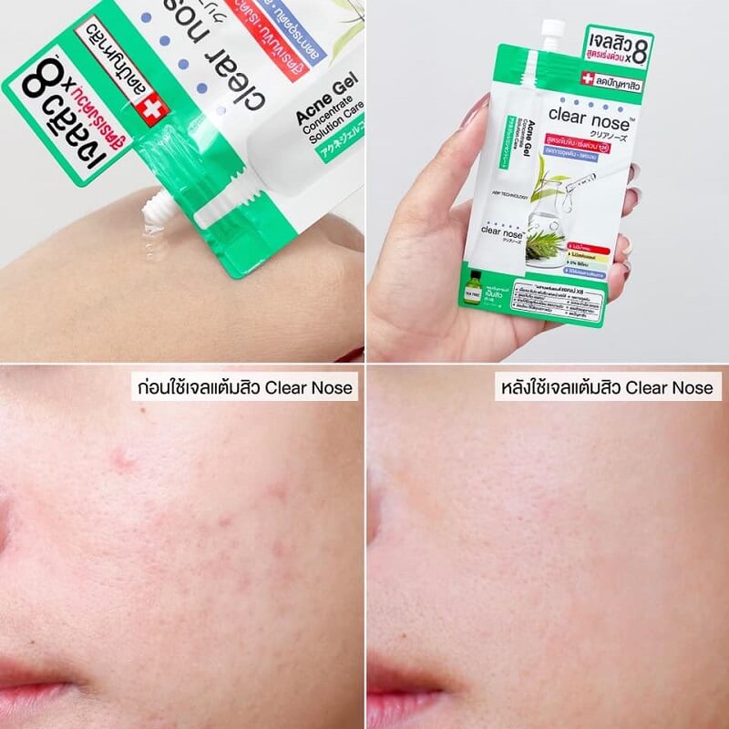 Clear Nose Acne Gel Concentrate Solution