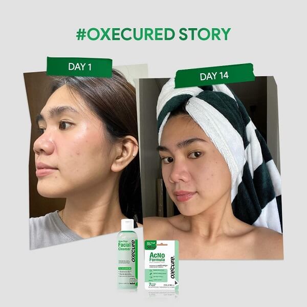 Oxe Cure Acne Clear Facial Cleanser - Image 12