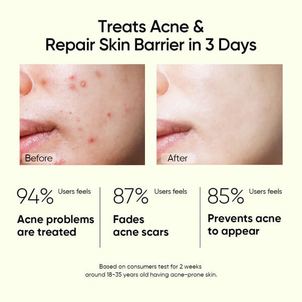 Skintific 2% Salicylic Acid Anti Acne Serum - Image 9