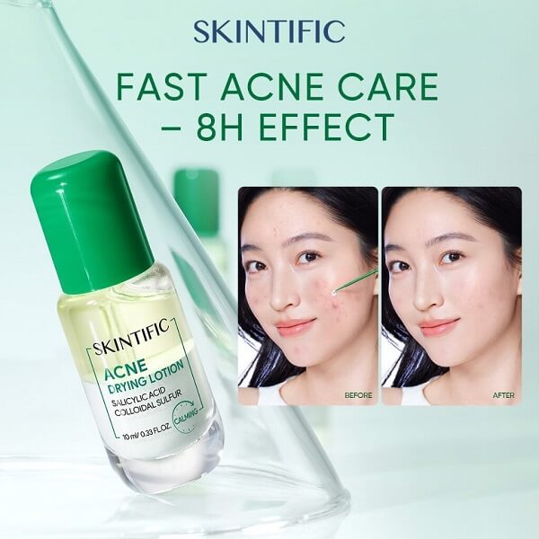 Skintific Acne Drying Lotion