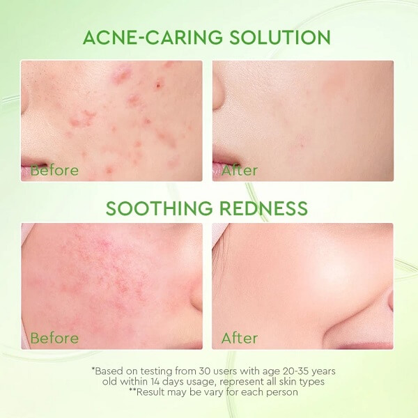Glad2Glow Kiwi 3D Acid Acne Moisturizer - Image 7